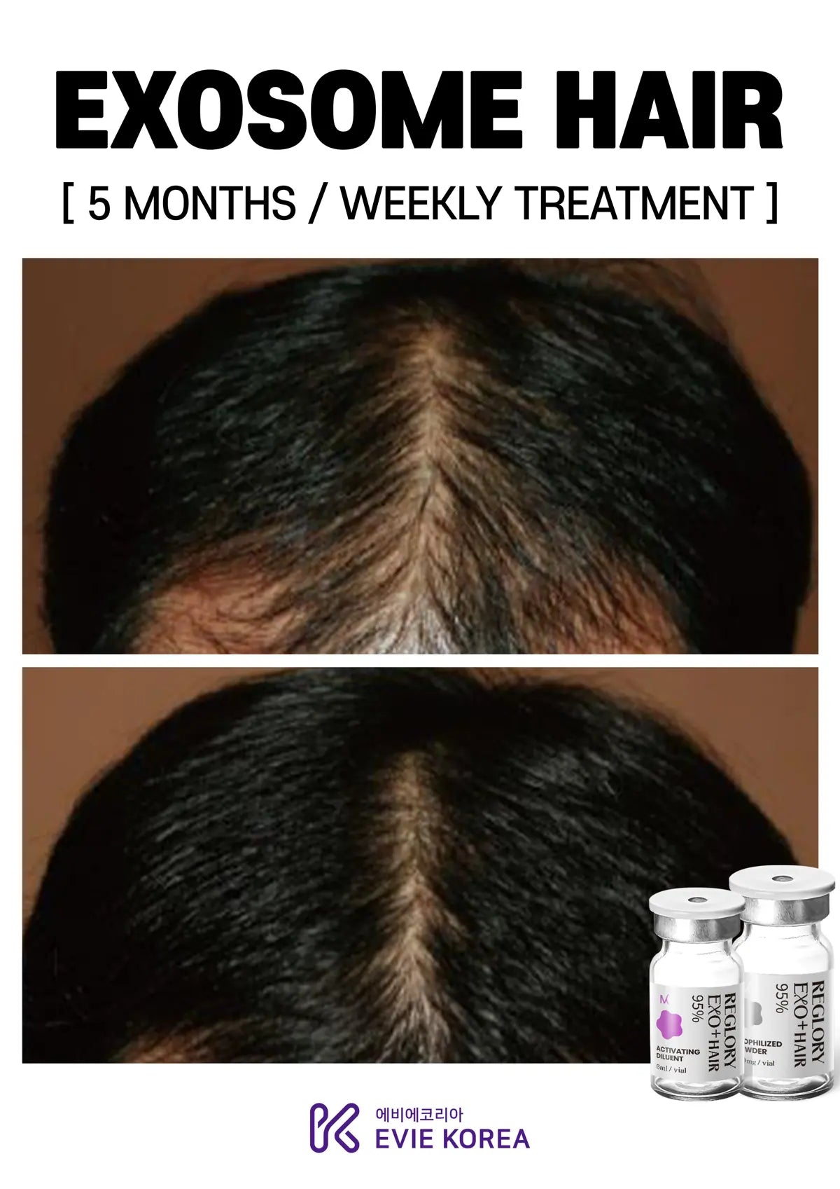 Reglory Exo+ Hair (Exosome) - 1x200mg+1x6ml