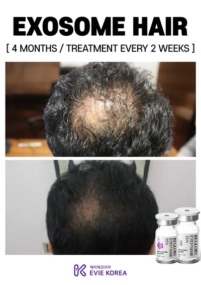 Reglory Exo+ Hair (Exosome) - 1x200mg+1x6ml